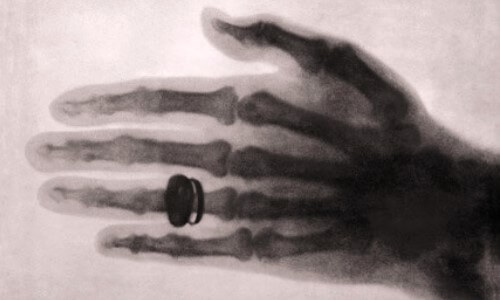 Rayos X: Primera Radiografía
